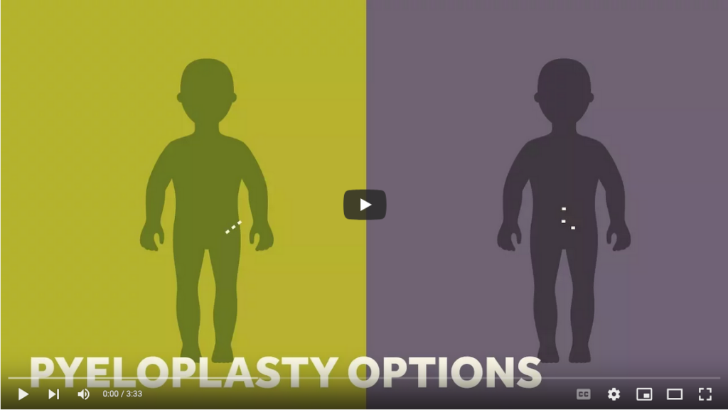 pyeloplasty infographic